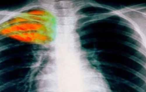 Ωρολογιακή βόμβα η φυματίωση στην Ελλάδα – Κάθε χρόνο 50 κρούσματα